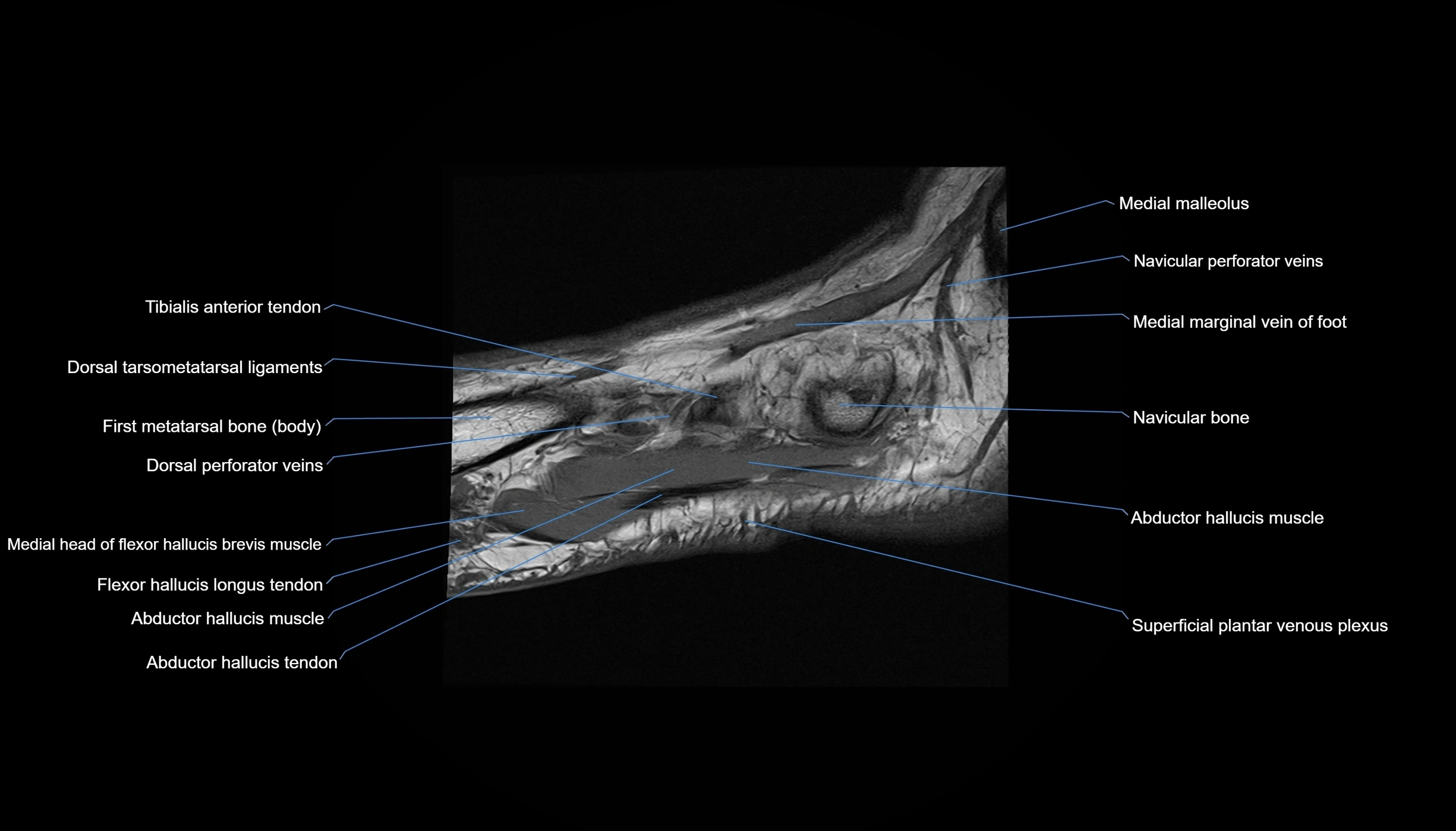 MRI mid foot sagittal cross sectional anatomy 3T  radiology  image-img-00001-00037.webp